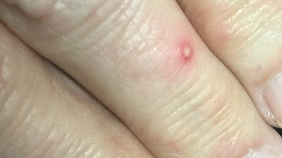 fire ant bite